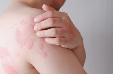 Dilgėlinė: simptomai, diagnostika ir gydymas