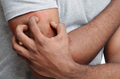Niežai: simptomai, diagnostika ir gydymas