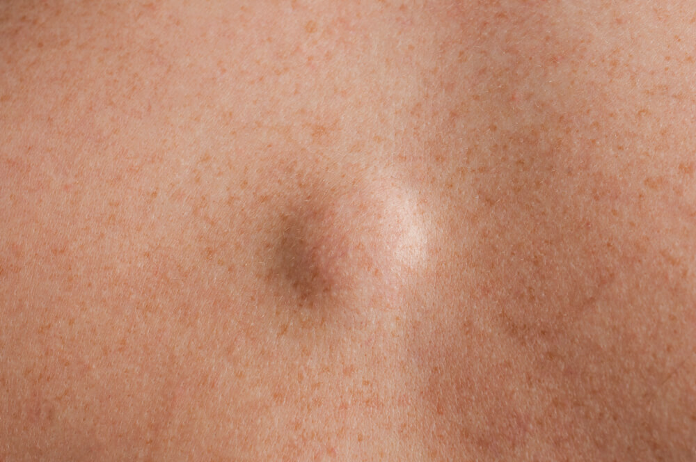 Lipoma po oda
